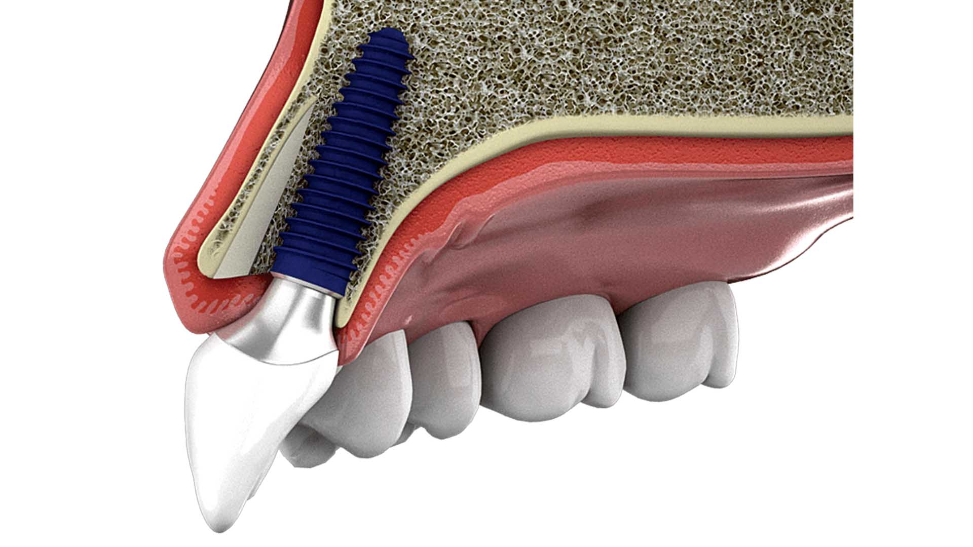 Root Membrane - Bone split